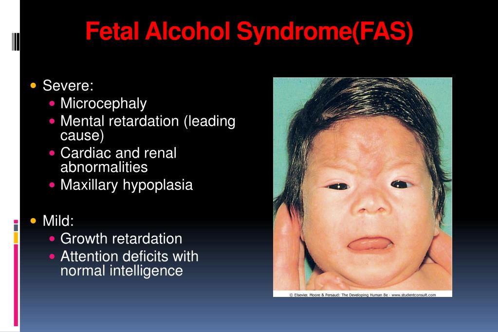 Causes Of Fetal Alcohol Syndrome