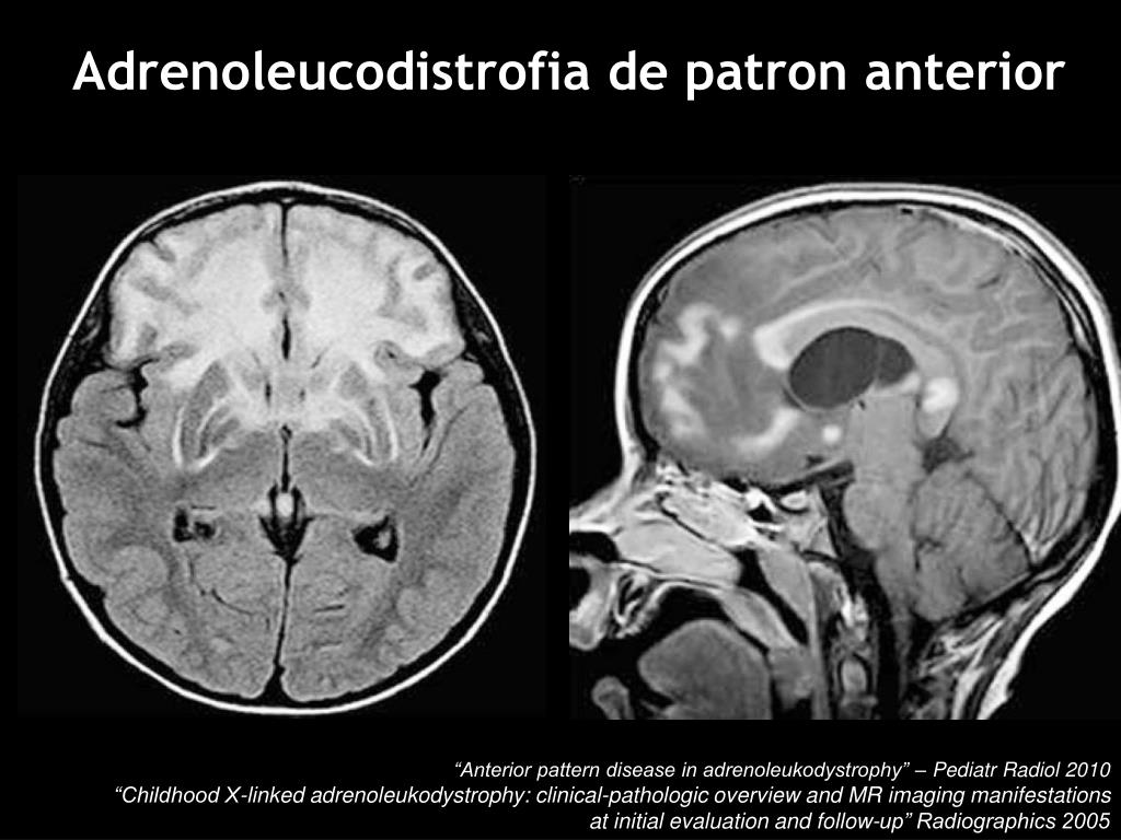 Radiografía cerebral de un paciente con adrenoleucodistrofia donde se ve afectada su sustancia blanca