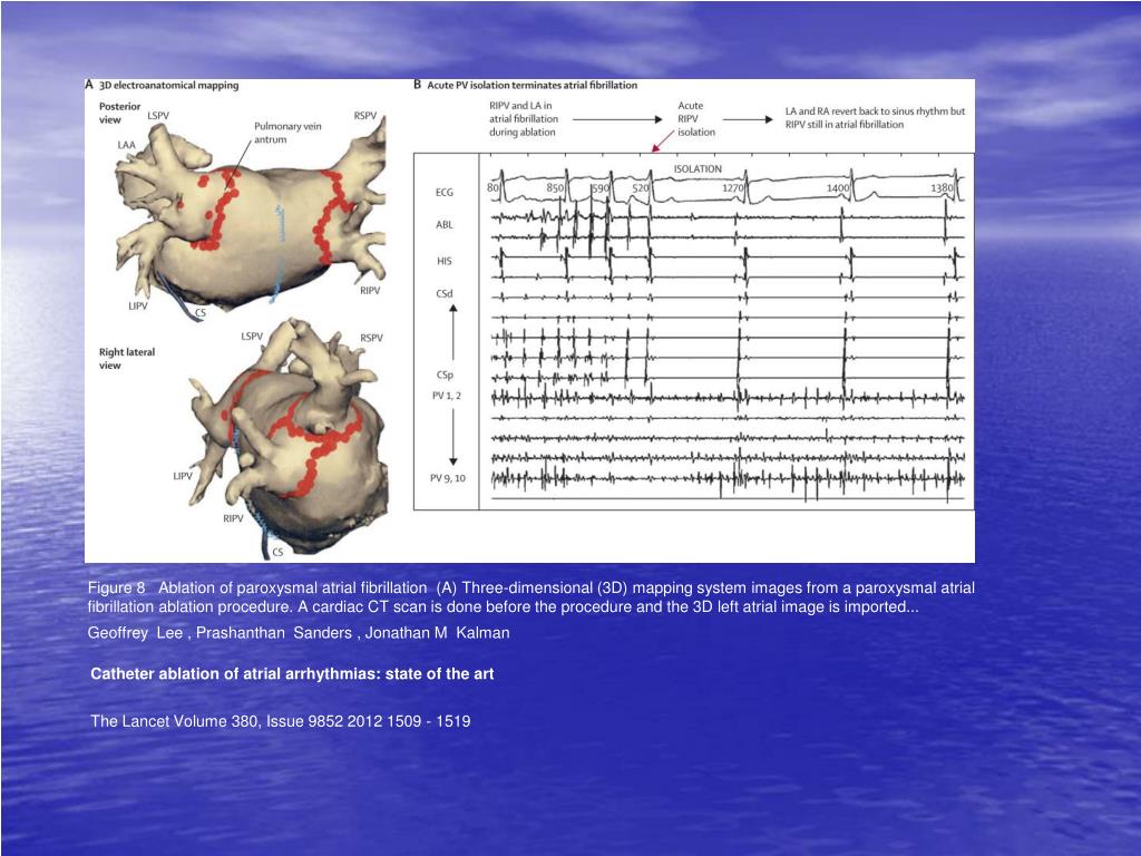 icd 10 a flutter