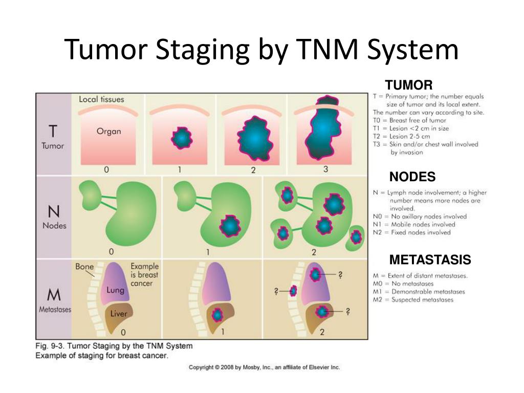 Stages of cancer. TNM classification of breast Cancer. Tumor Nodus metastasis классификация. Меланома TNM Staging. TNM молочной железы.