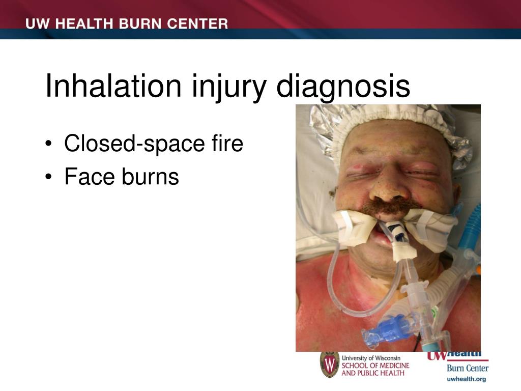PPT - Initial Burn Care PowerPoint Presentation, free download - ID:5076662