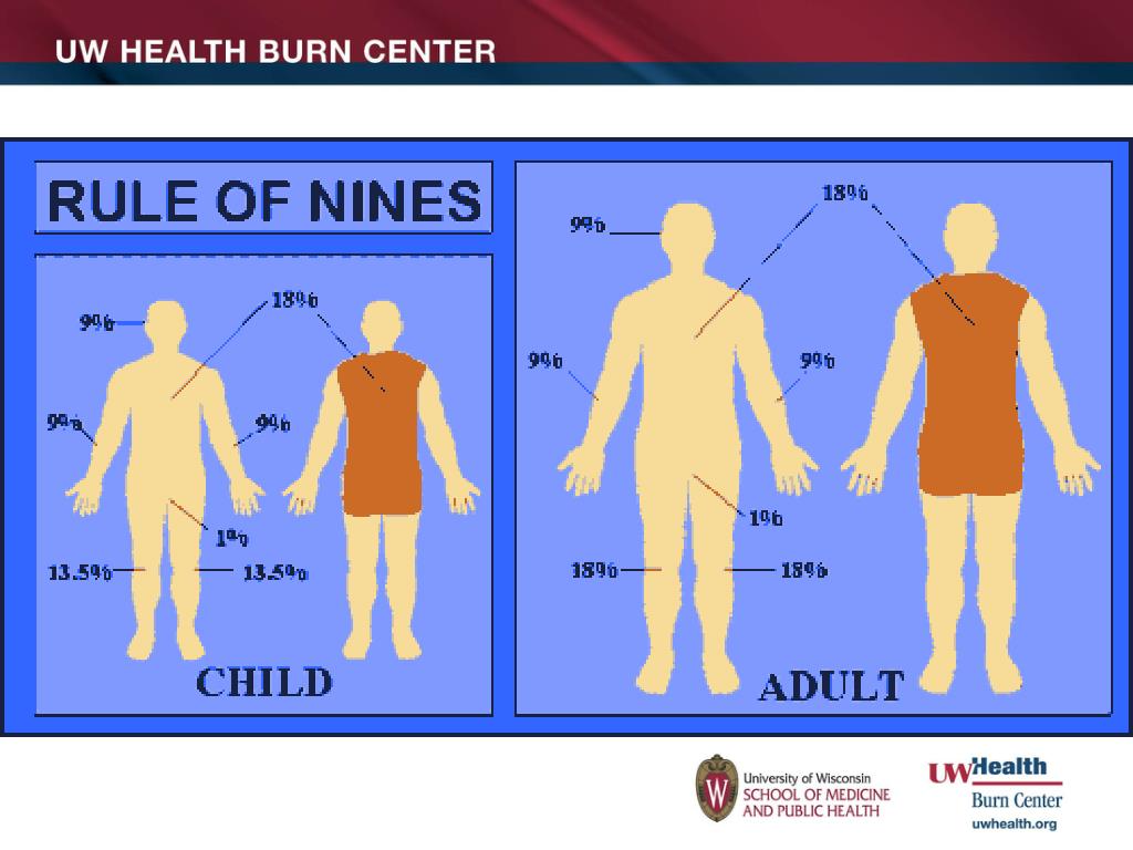 Rule Of Nines Burn Chart Children