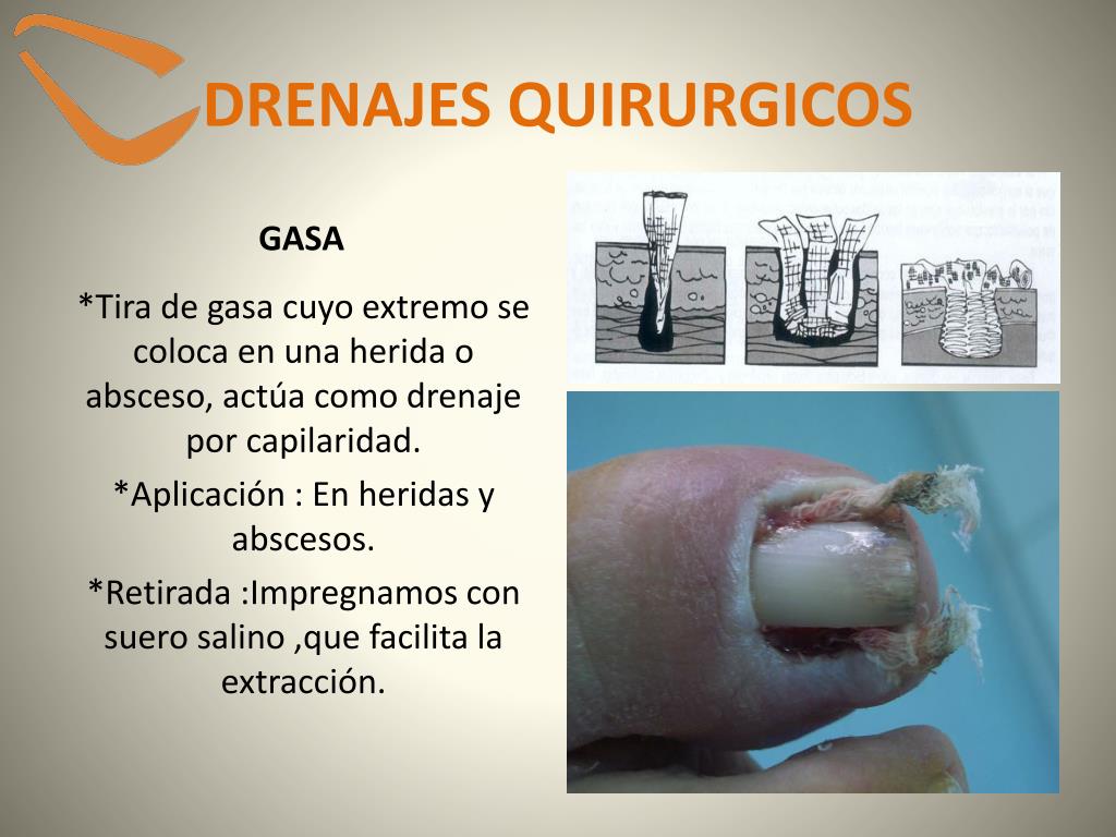 PPT - DRENAJES QUIRÚRGICOS PowerPoint Presentation, free download -  ID:5076774
