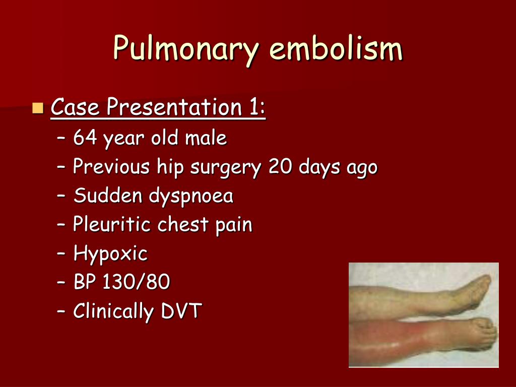 case study of patient with pulmonary embolism