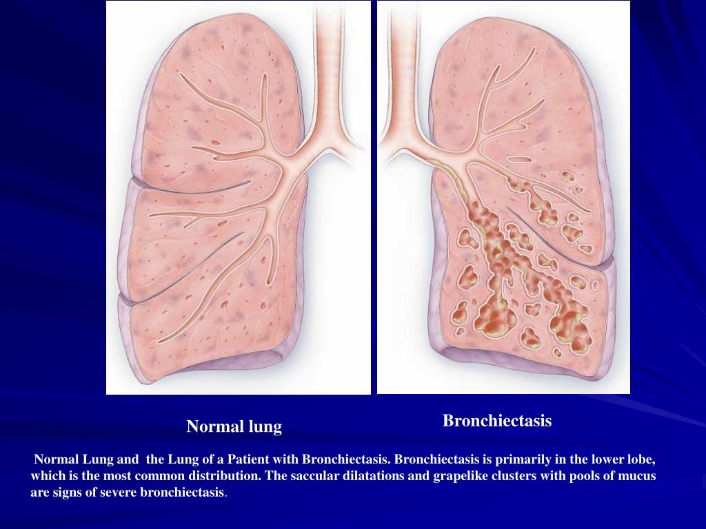 PPT - Bronchiectasis Hu Suping Pulmonary Department 1st clinical ...