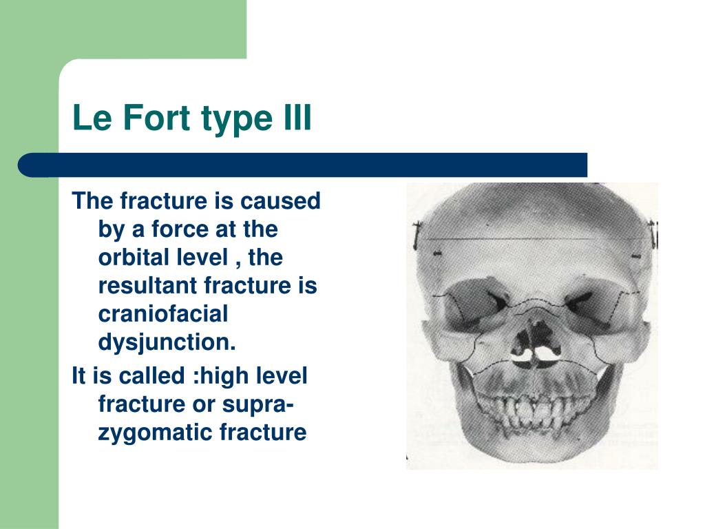 PPT - MIDFACE FRACTURES PowerPoint Presentation, free download - ID:5119750