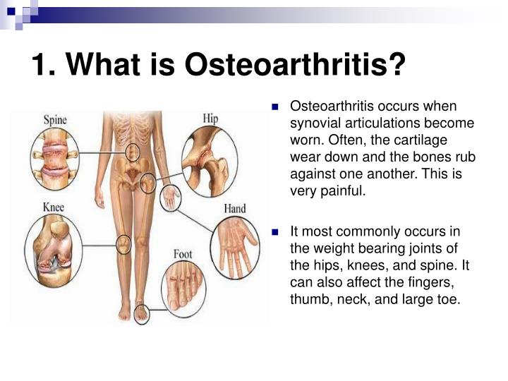 PPT Osteoarthritis PowerPoint Presentation ID:5131778