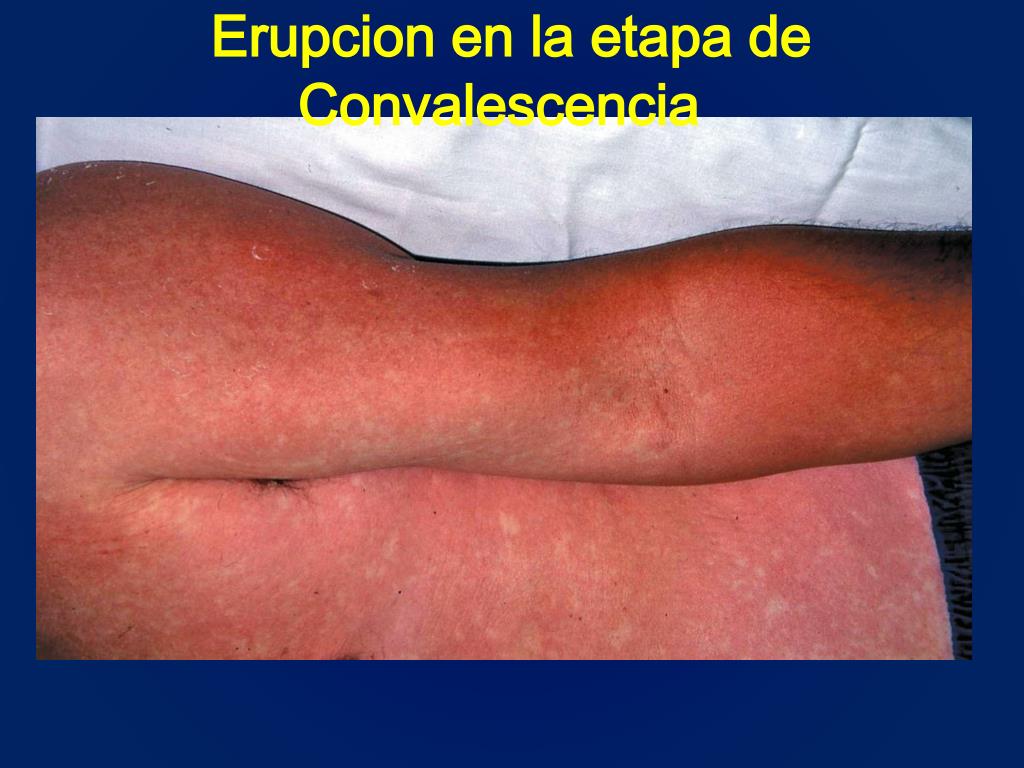 PPT - Enfermedades Infecciosas Prevalentes en la Libertad DENGUE