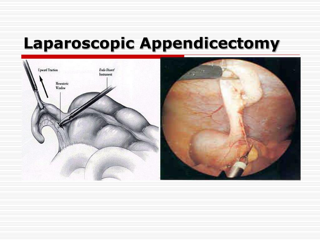 PPT - Appendicitis in children PowerPoint Presentation, free download ...