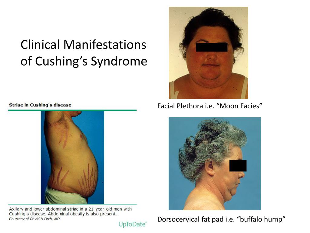 PPT Cushing’s Syndrom e PowerPoint Presentation, free download ID