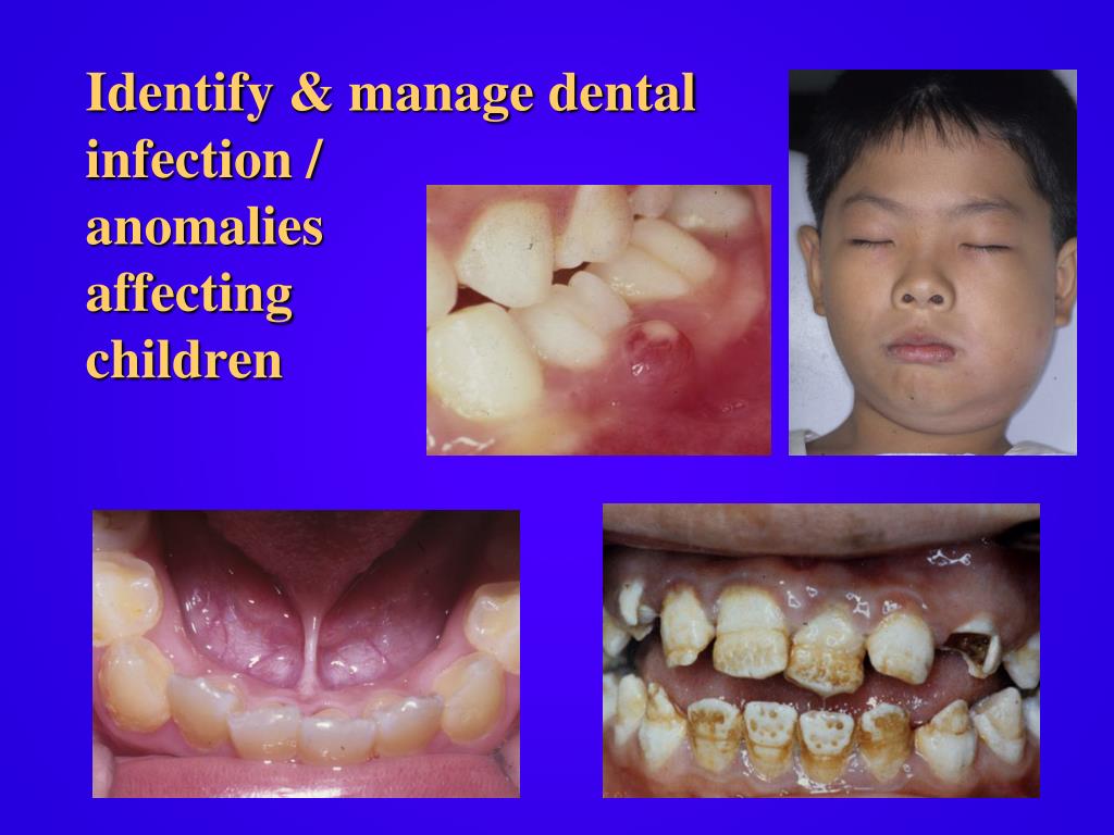 PPT - Introduction to Paediatric Dentistry PowerPoint Presentation ...