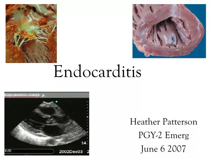 endocarditis n.