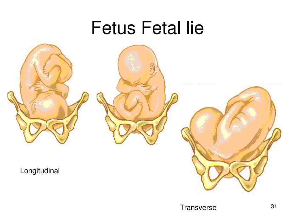 presentation fetal lie