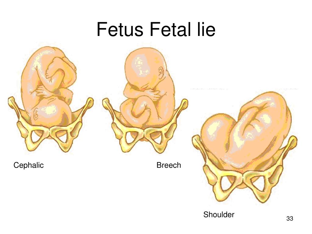 foetal presentation is cephalic