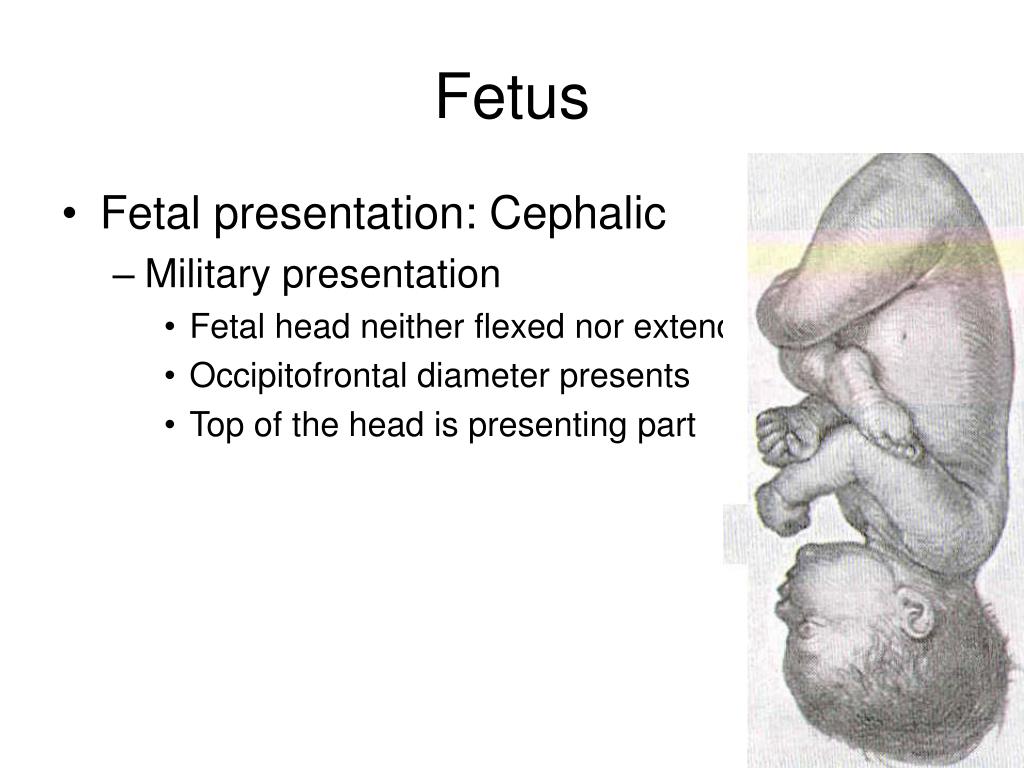 military presentation of fetus