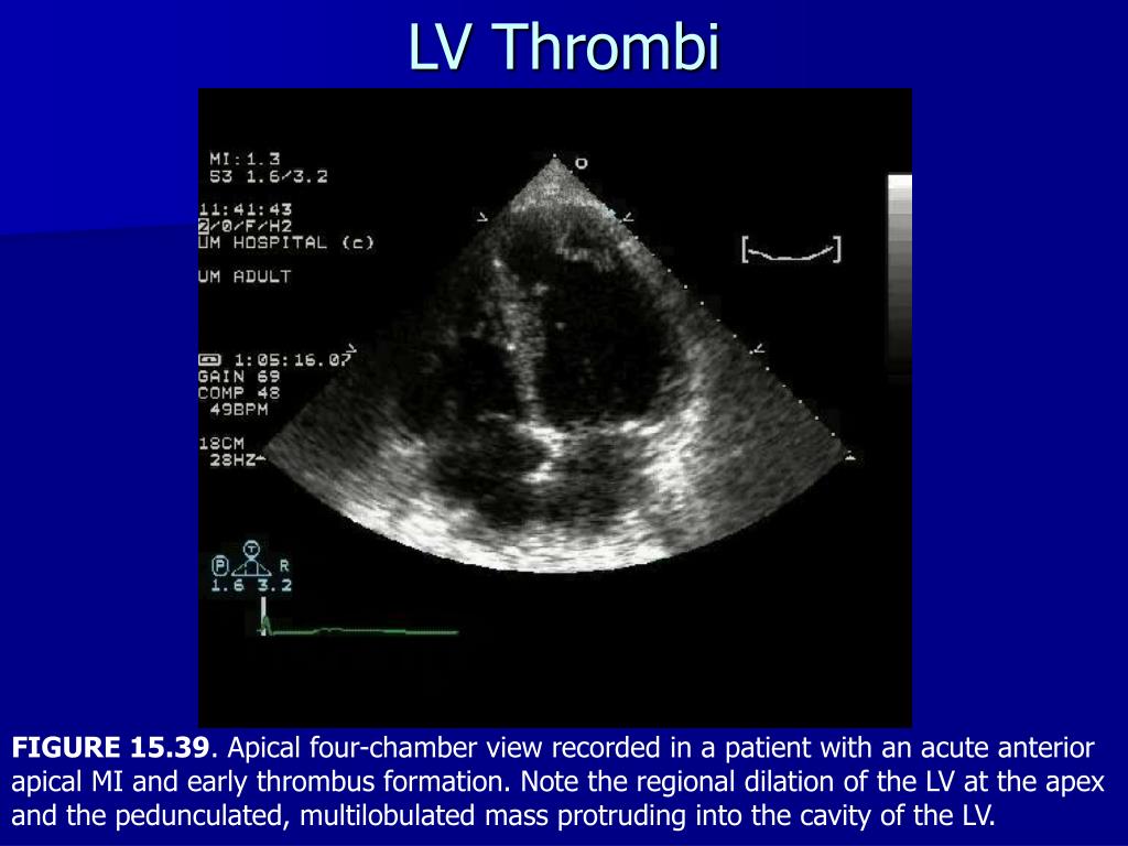 PPT - Echocardiography in the Evaluation of Intracardiac Sources of Embolism PowerPoint ...