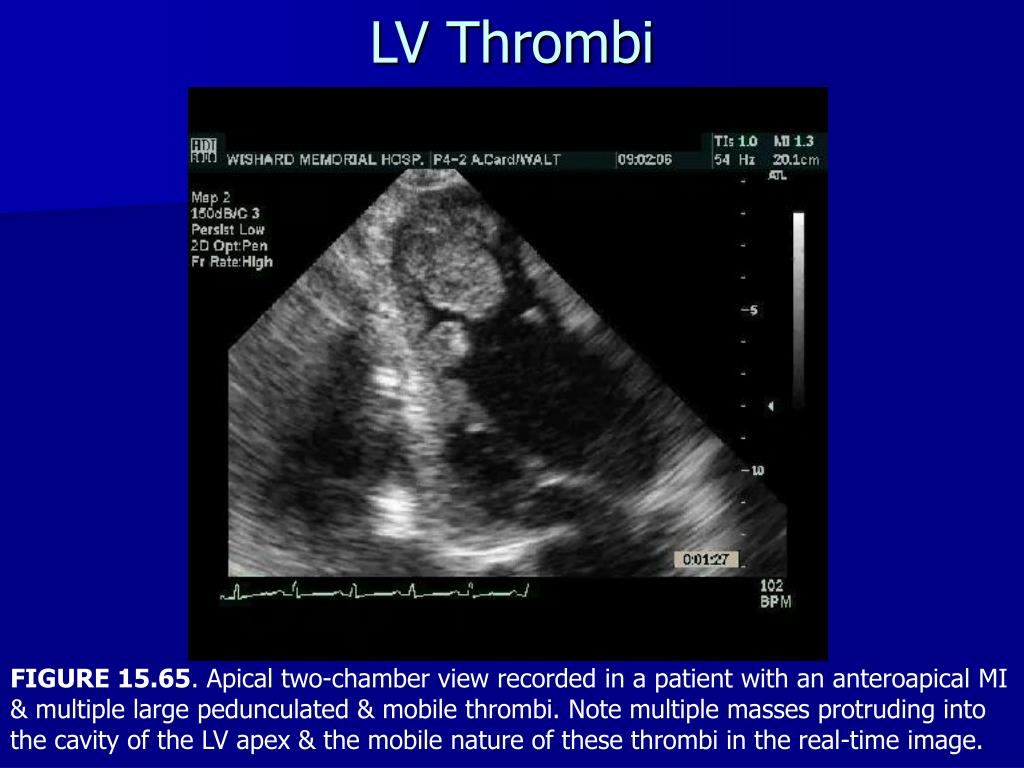 PPT - Echocardiography in the Evaluation of Intracardiac Sources of Embolism PowerPoint ...