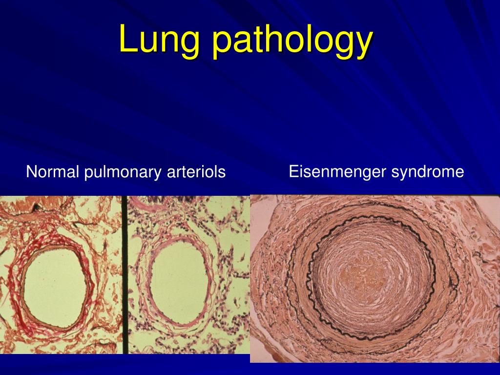 PPT Eisenmenger Syndrome in Adults with Congenital Heart Disease