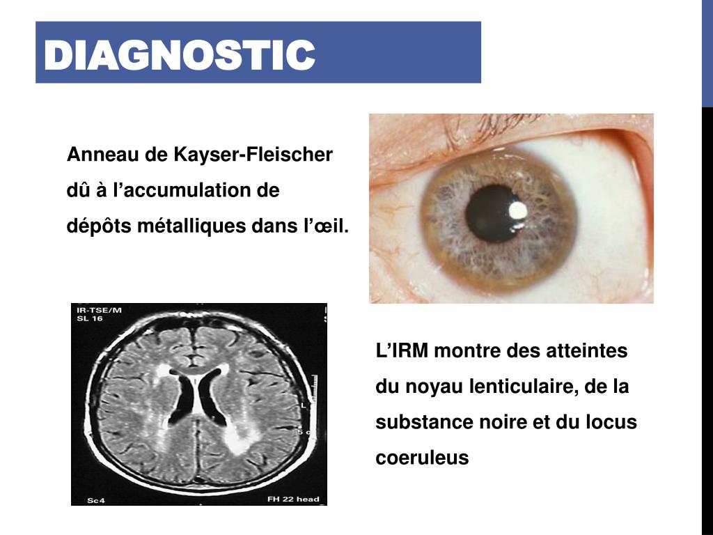 PPT La Maladie de wilson PowerPoint Presentation, free download ID