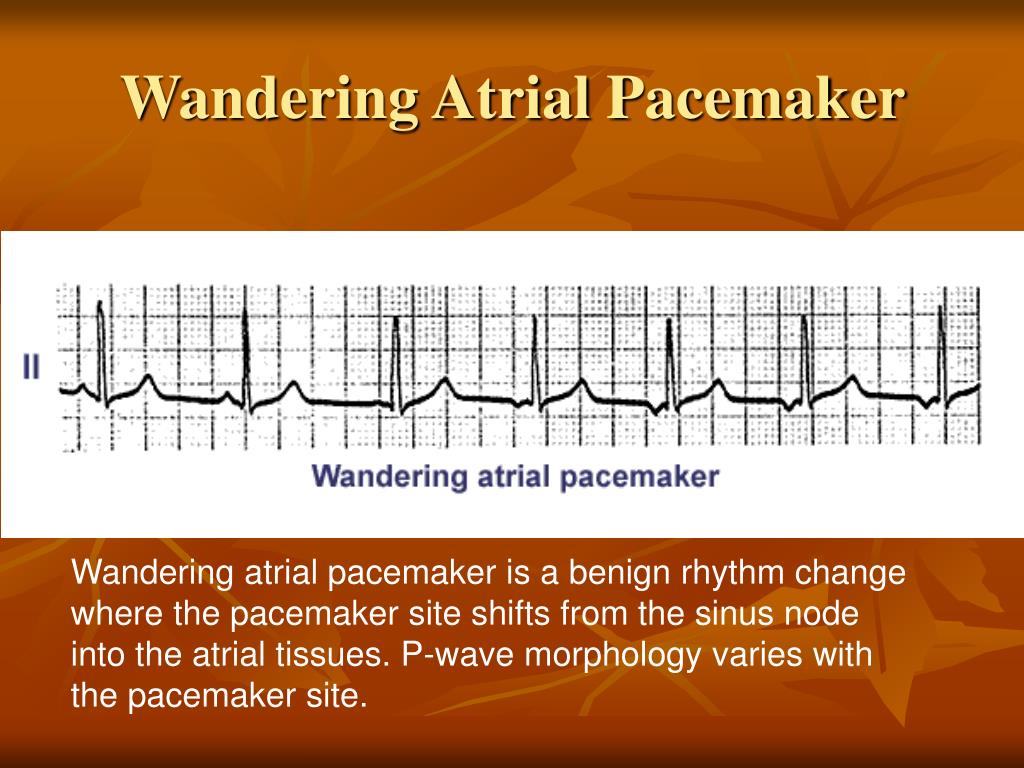 wandering atrial pacemaker regular or irregular
