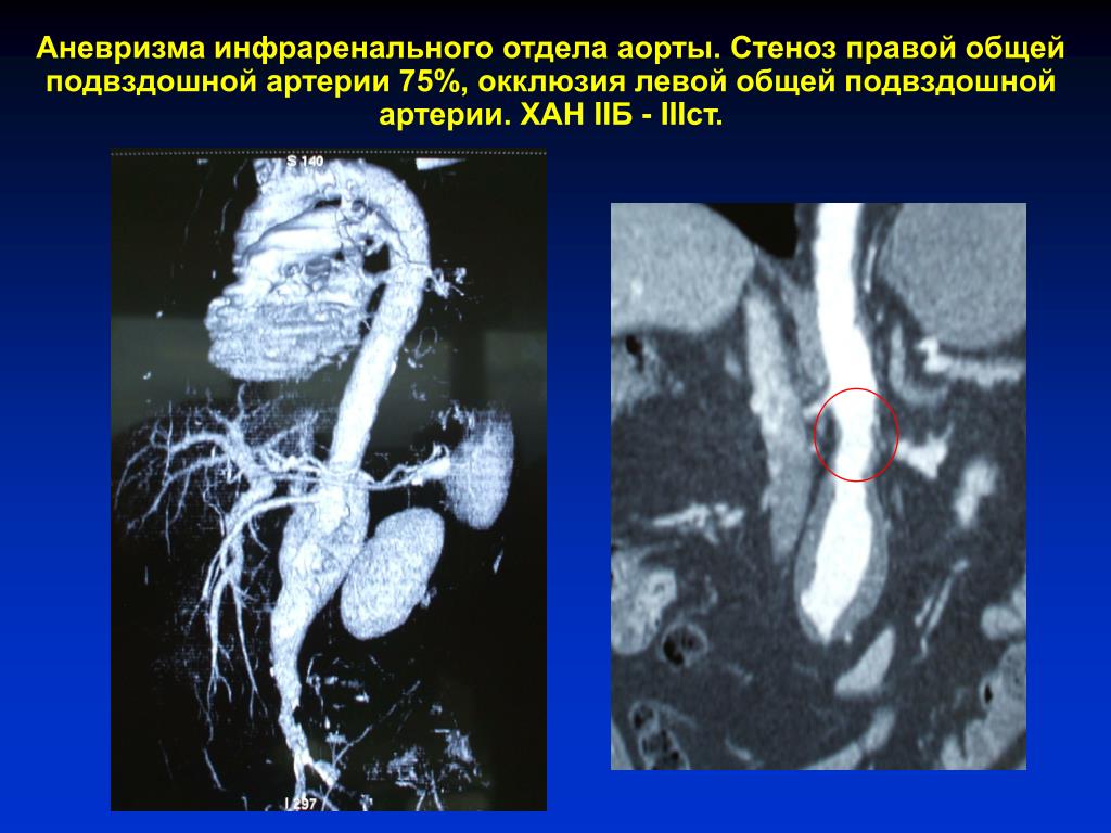 Диагностика аневризмы брюшной аорты симптомы. Расслаивающаяся аневризма брюшного отдела аорты. Веретенообразная аневризма инфраренального отдела брюшной аорты. Аневризма бифуркации аорты. Веретенообразная аневризма брюшной аорты кт.