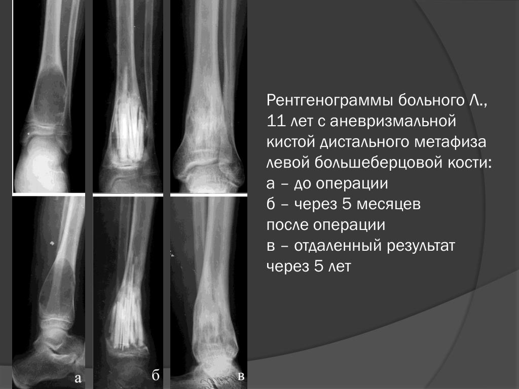 Поражение костей