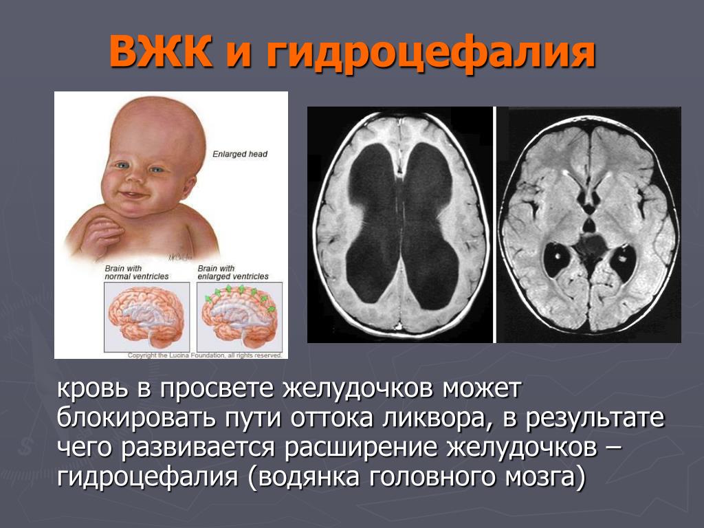 Расширение боковых рогов. Гидроцефалия норма желудочков. Гидроцефалия 4 степени. Врожденная гидроцефалия. Водянка желудочков головного мозга.