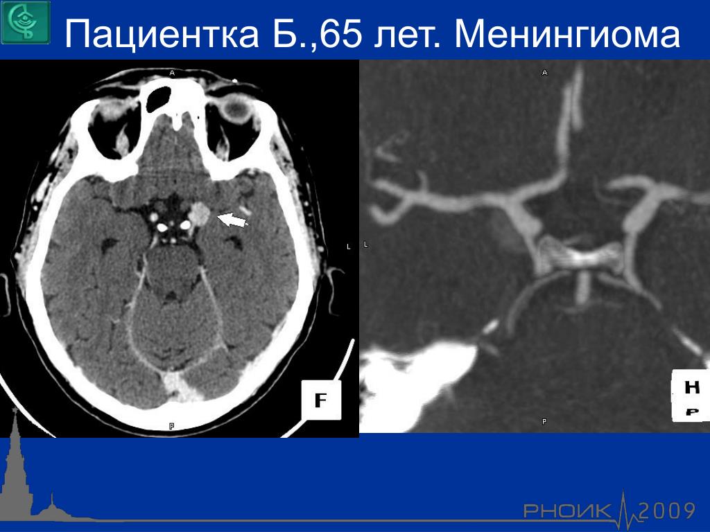 Менингиома позвоночника