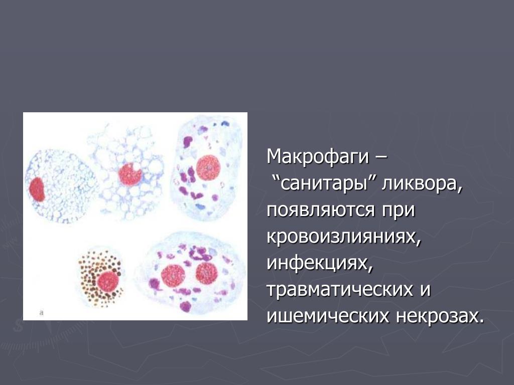 Эритроциты макрофаги. Макрофаги в спинномозговой жидкости. Макрофаг с гемосидерином в ликворе. Клеточные элементы в ликворе. Лимфоциты в спинномозговой жидкости.