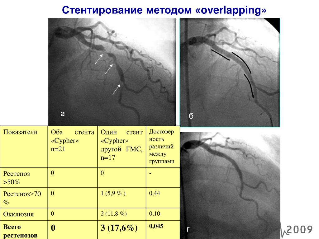 Можно ли после стентирования