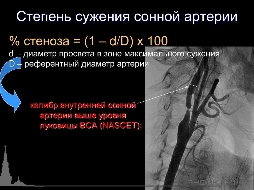 Сужение правой артерии. Стеноз внутренней сонной артерии слева 50. Степени стеноза внутренней сонной артерии. Диаметр внутренней сонной артерии. Степени сужения сонных артерий.