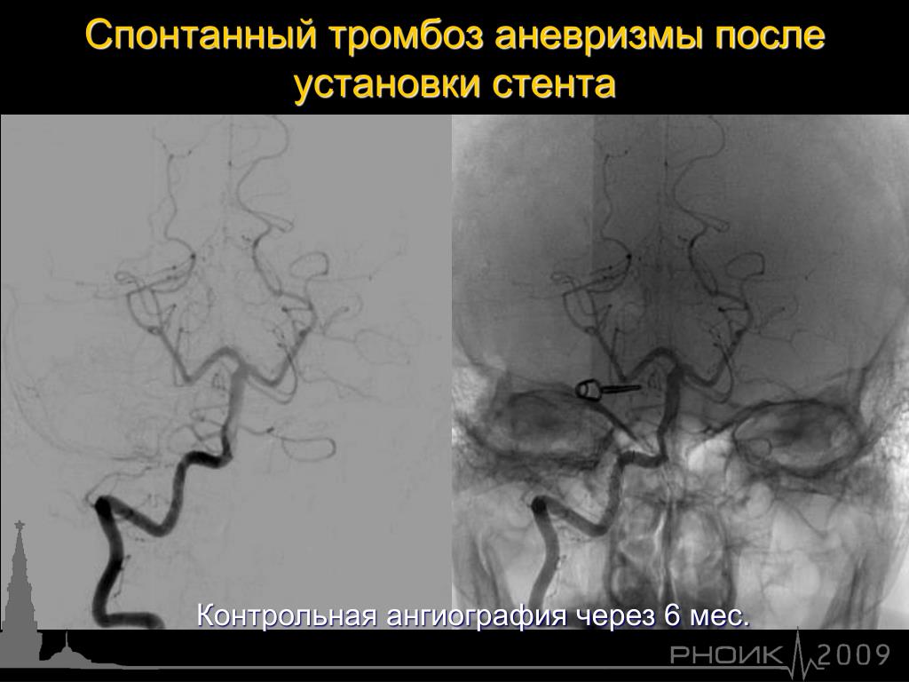 Аневризма головного мозга эндоваскулярным. Ангиография аневризма. Аневризма головного мозга рентген. Интракраниальные аневризмы. Тромбированная аневризма кт.
