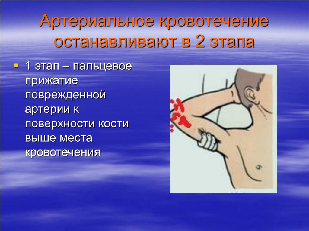 При артериальном кровотечении ответ на тест. Артериальное кровотечение останавливают в два этапа. Артериальное кровотечение останавливается в два этапа. Этапы остановки кровотечения. Остановка артериального кровотечения.