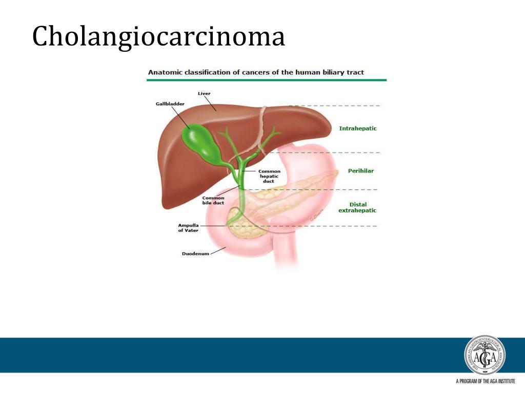 PPT - Primary Liver Cancer: Hepatocellular Carcinoma and ...