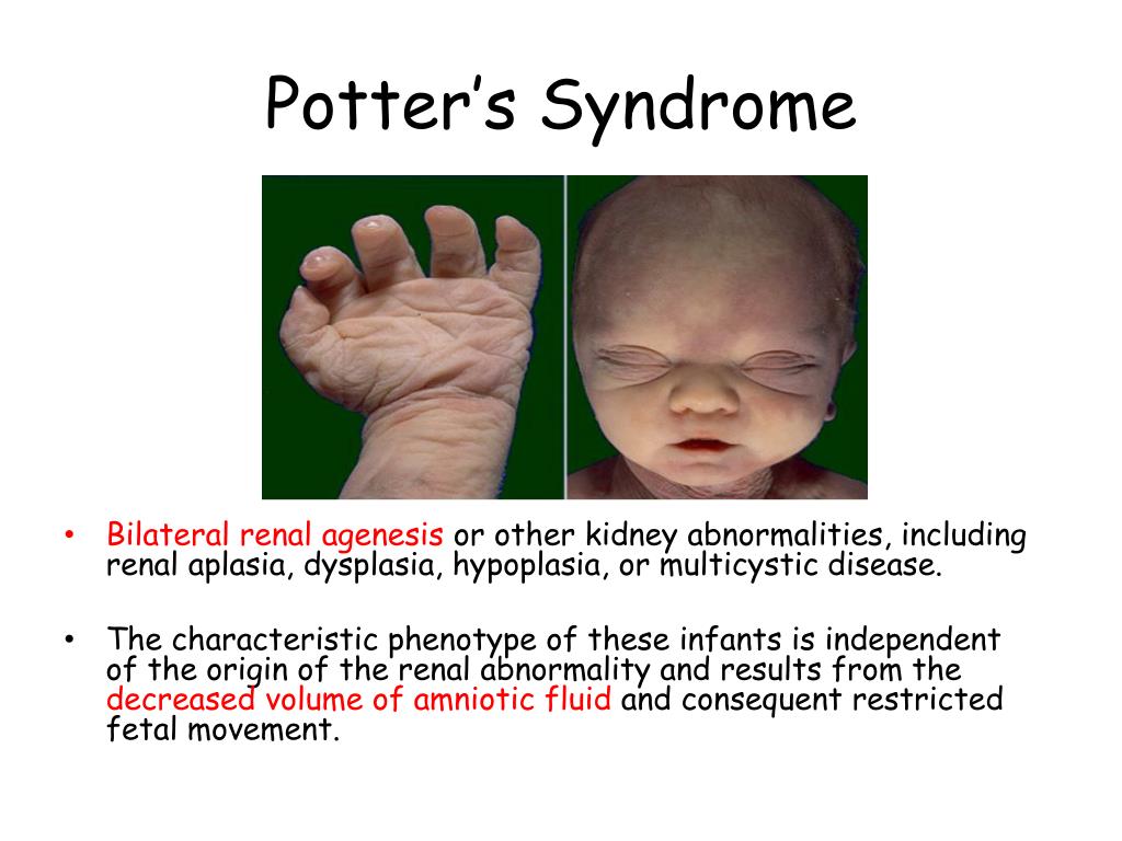 PPT Inherited of Renal System Disorders PowerPoint Presentation, free