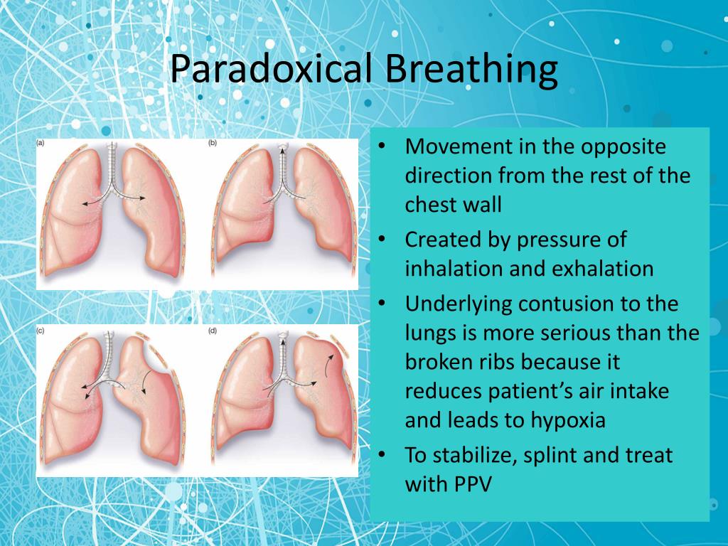 PPT Chest Trauma PowerPoint Presentation, free download ID5319182