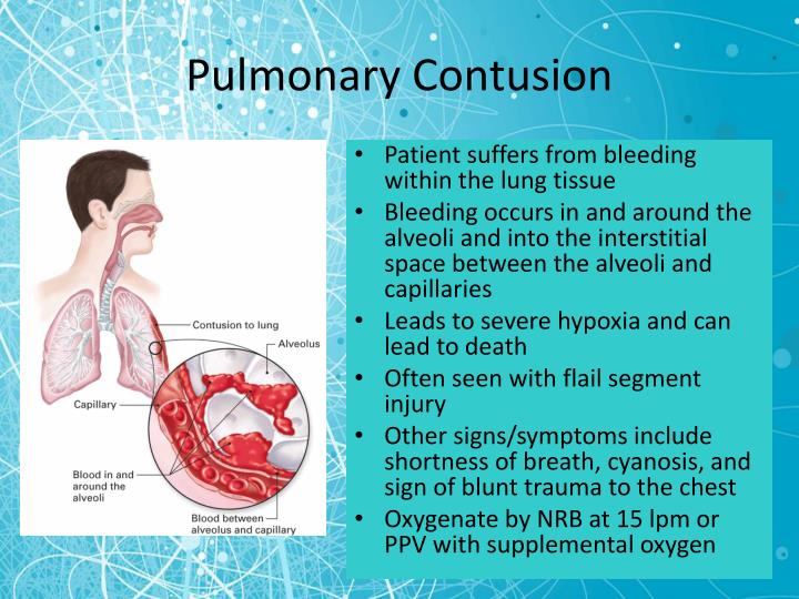 Contusion Pulmonar