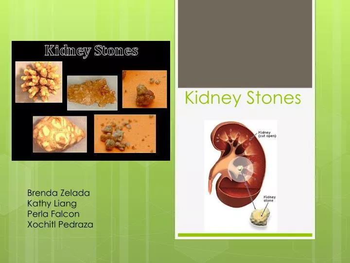 presentation on kidney stones