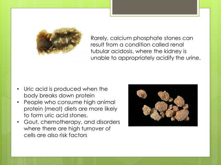 PPT Kidney Stones PowerPoint Presentation ID5322285