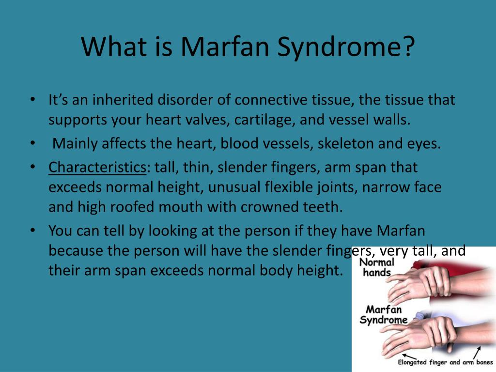 Marfan Syndrome Types