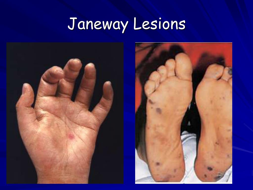 Janeway Lesion Janeway Lesion A Forgotten Entity VFZJOZ