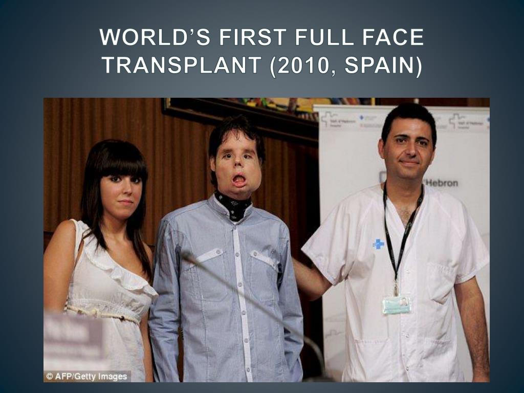 Донорство лица. Самая сложная операция в мире. Люди с полной трансплантацией лица.