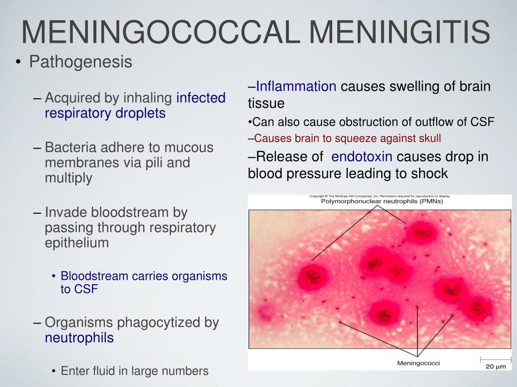 Image result for meningococcal meningitis