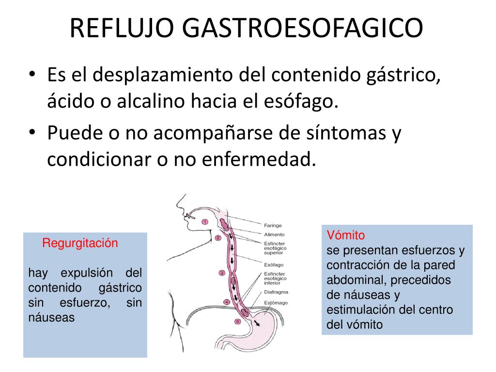 Que significa reflujo gastroesofágico