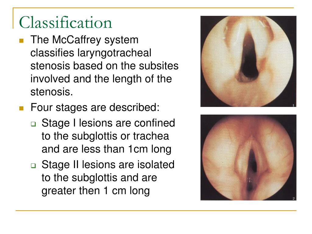 PPT Congenital Anomalies of Larynx PowerPoint Presentation, free