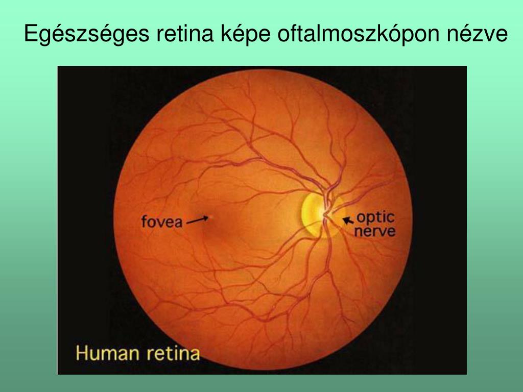 Норма зрительного нерва. Офтальмоскопия глазного дна норма. Описание глазного дна в норме. Нормальная картина глазного дна.